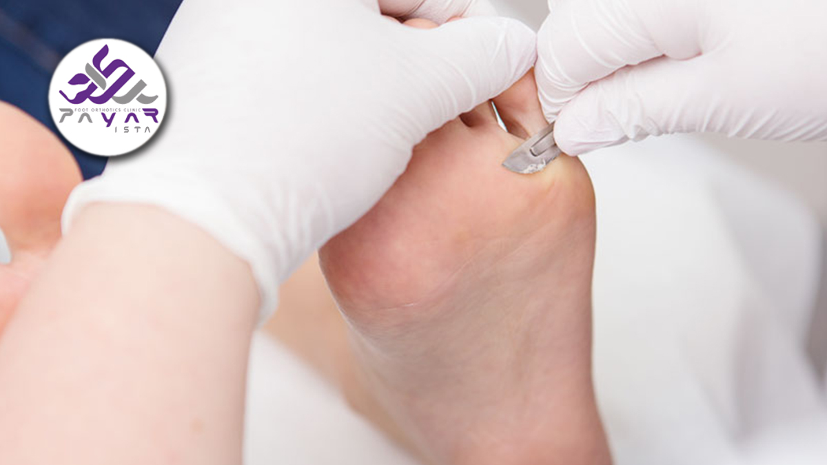 میخچه یا پینه پا چه علائمی دارد؟ جلوگیری و درمان با کفش و کفی طبی و جراحی